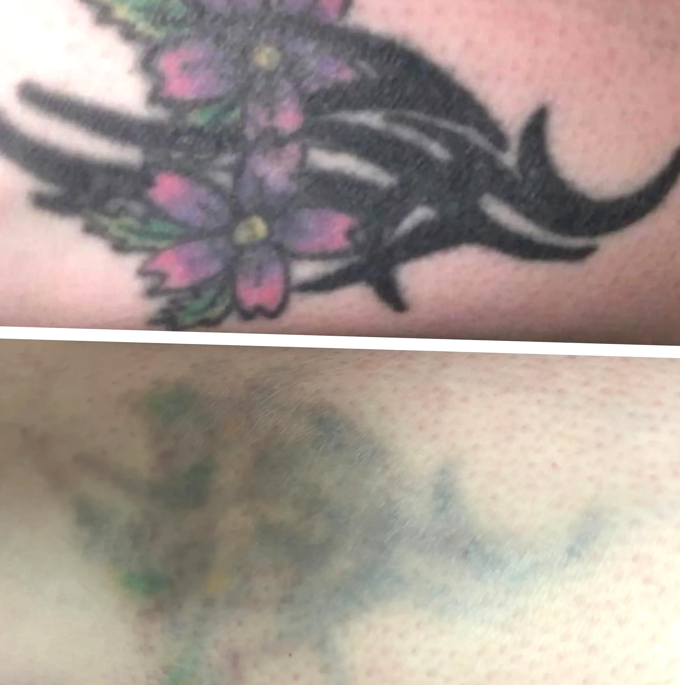 saline tattoo removal aftercare